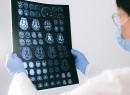 Czy choroba Alzheimera ma podłoże genetyczne?