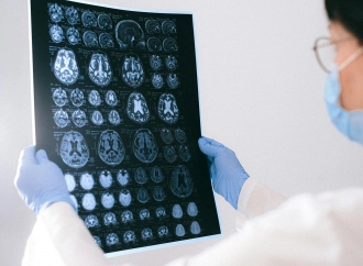 Czy choroba Alzheimera ma podłoże genetyczne?